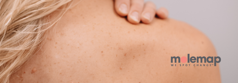 Back of womans shoulder showing freckles. MoleMap Logo on bottom right corner